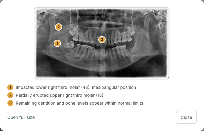 An X-ray in DentoKeep with AI-generated findings pinned to specific spots on the image, each with a one-line diagnosis